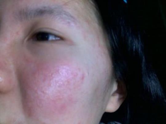 脸总过敏怎么办 过敏怎么办?又红又痒