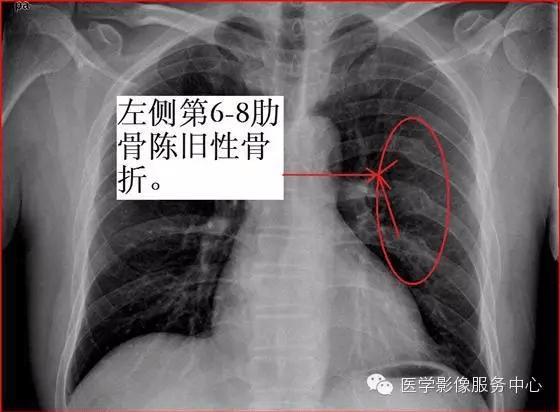 肋骨骨折算几级伤残伤到肺 肋骨骨折几级伤残鉴定