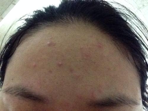 额头长痘痘涂什么药膏 额头长痘痘什么原因引起的