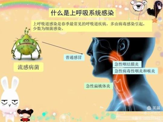 急性呼吸道感染 急性咽炎的症状和最佳疗法