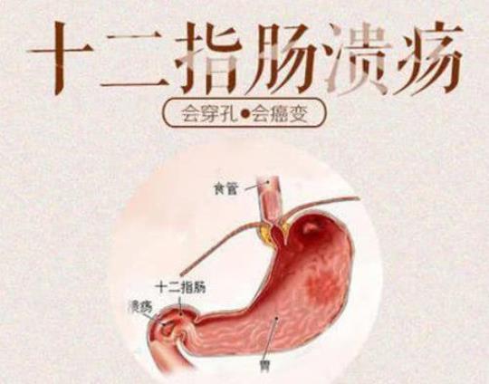 十二指肠溃疡的饮食 