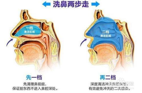 盐水洗鼻的方法图解 