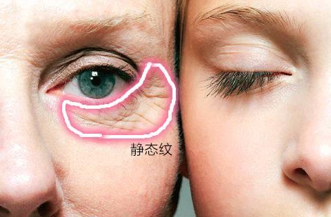 眼纹类型 怎么判断眼纹类型